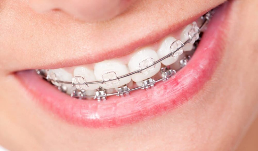 clear braces